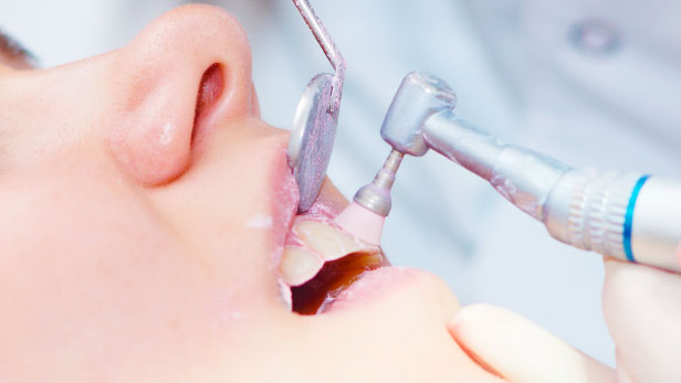 Teeth Cleaning & Polishing